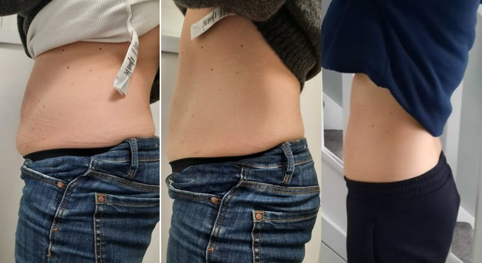 slimming treatment Athlone
