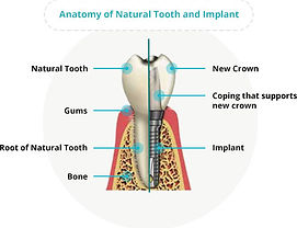 Dental implant anatomy.jpg