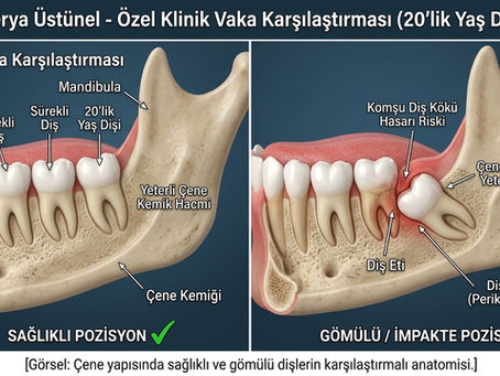 20'lik yaş dişleri ve gömülü diş çene anatomisi karşılaştırmalı diyagramı