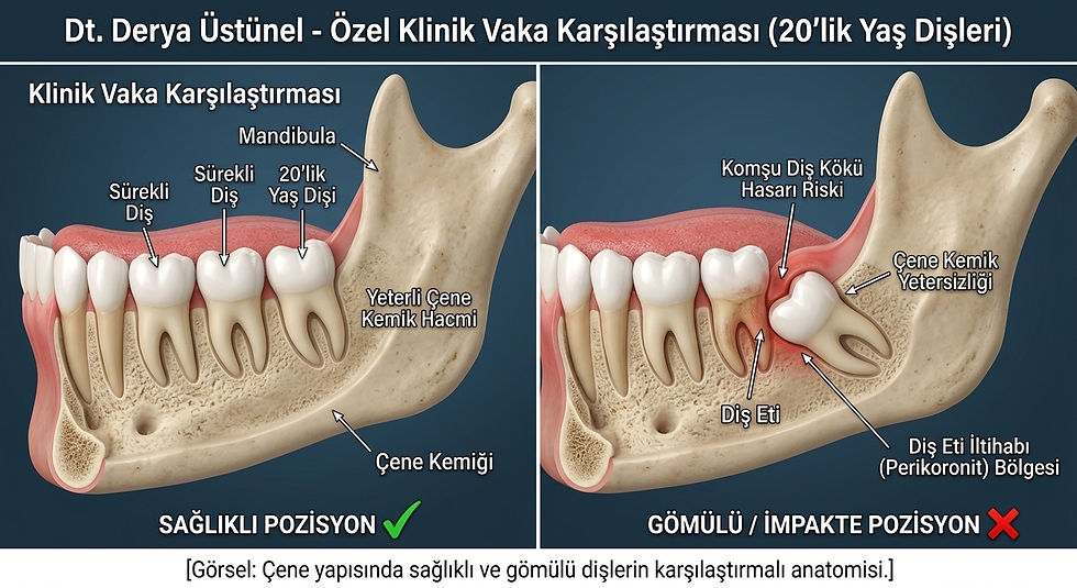 20'lik yaş dişleri ve gömülü diş çene anatomisi karşılaştırmalı diyagramı