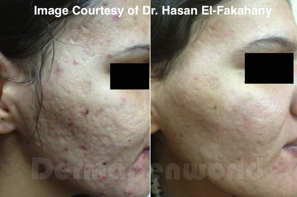 Dermapen acne scarring treatment