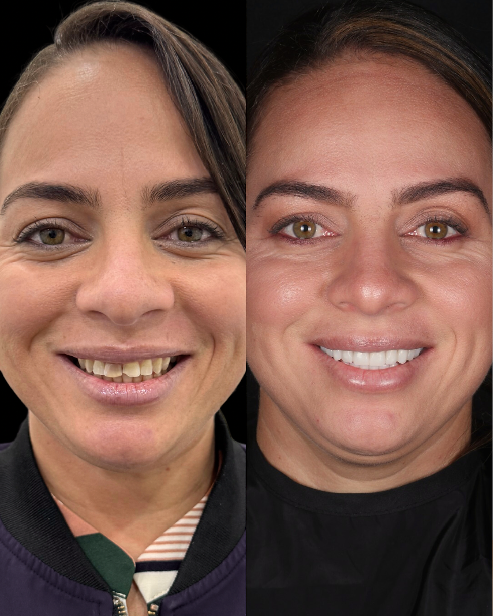 Vista frontal cercana de una sonrisa blanca y alineada después de un diseño de sonrisa
