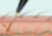 Electroysis.jpg