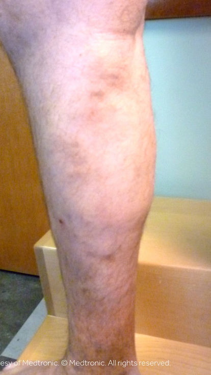 after-procedure