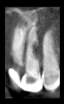 Reabsorciones radiculares, cuáles son sus causas