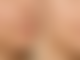 What Is Microneedling PRF and How Does It Work?