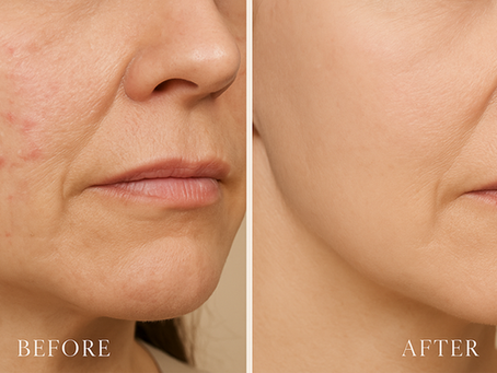 What Is Microneedling PRF and How Does It Work?
