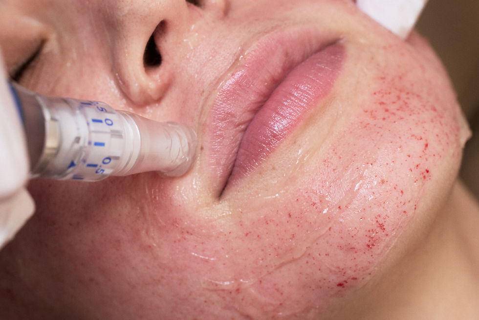 Microneedling in North Tampa at Zi Medspa