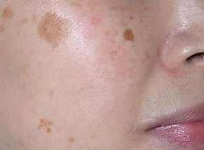 Brown spot removal, melasma removal, pigmentation removal Singapore.