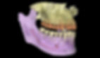Printed CBCT for Treatment Planning - Zygoma Implants