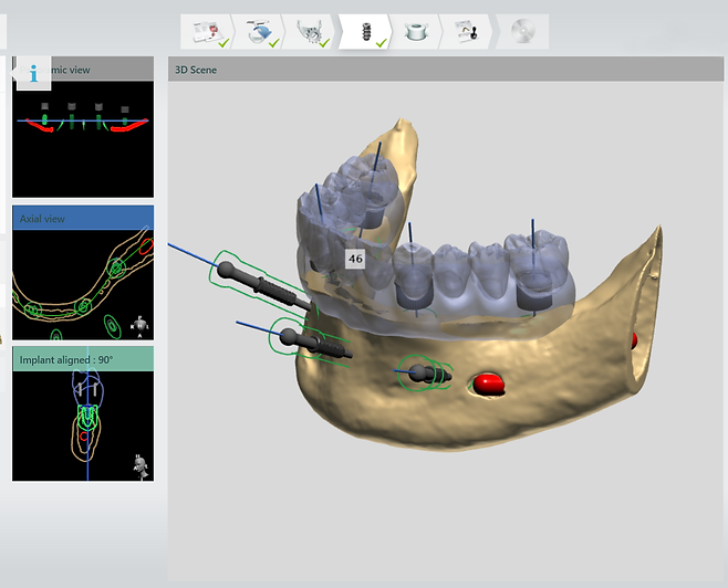 CBCT and virtual restoration overlay for implant planning and prosthetic-driven axes visualization