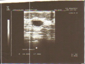 Sonogram photo