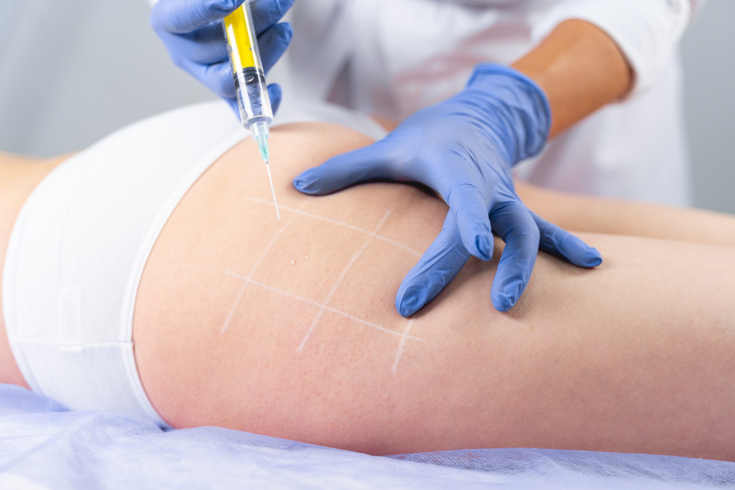 Fat dissolve injections