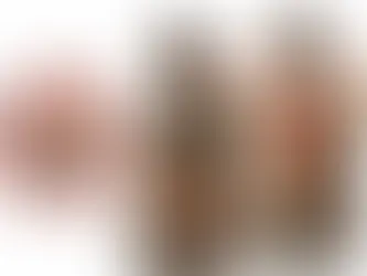 Embolisation des fibromes utérins vs hystérectomie dans les Yvelines (78) : quelles différences pour les patientes ? | RADIOLOGIE INTERVENTIONNELLE 78