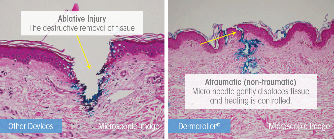 ablative-vs-atraumatic.gif