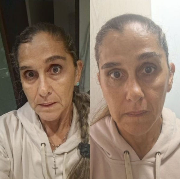 Miniatura: BOTOX NATURAL