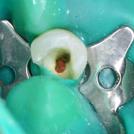 Root Canal Therapy