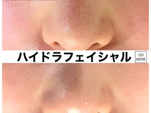 ハイドラで毛穴の汚れをごっそり除去!