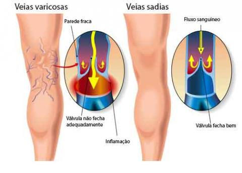 veias-varicosas.jpg