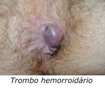 Hemorróidas