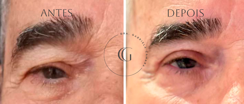 antes e depois de uma cirurgia de pálpebras