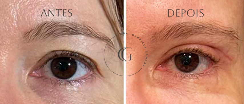 antes e depois blefaroplastia