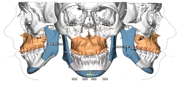 planejamento virtual cirurgia ortognatica