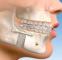 cirurgia ortognatica