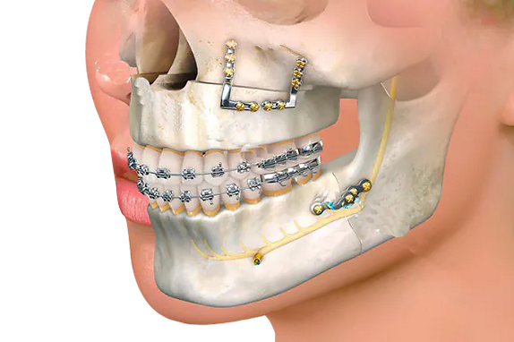 cirurgia ortognatica