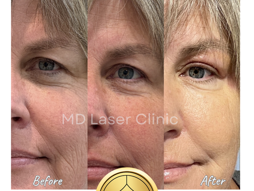Experience the Power of Plexrplasty Soft-Surgery with Plexr Plasma