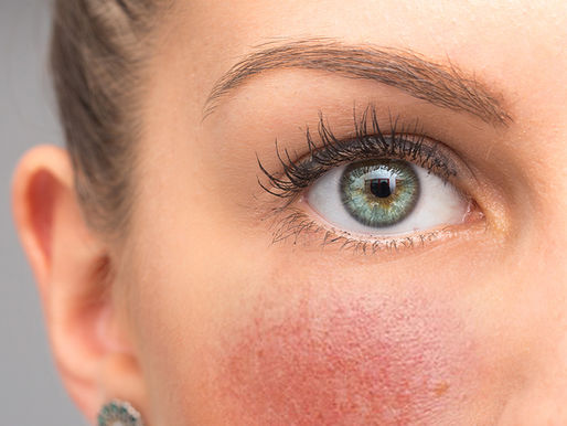 Rosacea: Symptoms, Causes, Triggers & Recommended Treatment