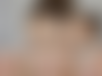 Melasma: Causes, Triggers & Treatments in Burlington