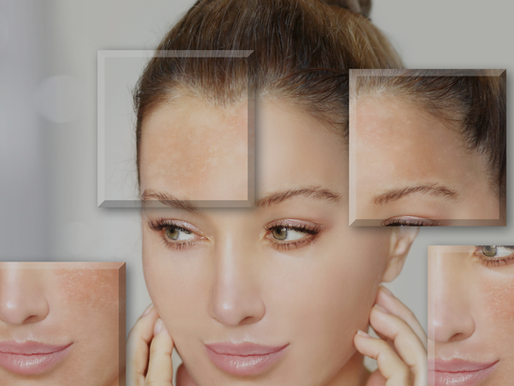 Melasma: Causes, Triggers & Treatments in Burlington