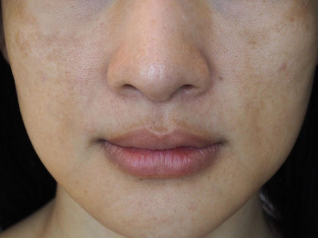 Do Chemical Peels Really Remove Hyperpigmentation?