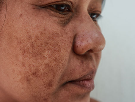 Understanding Melasma: Causes, Treatment, and Prevention