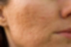 A woman with acne scars.