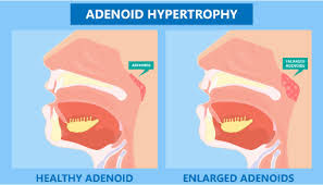 How Enlarged Tonsils and Adenoids Affect Children’s Growth, Sleep, and Dental Development — And How Myofunctional Therapy Can Help