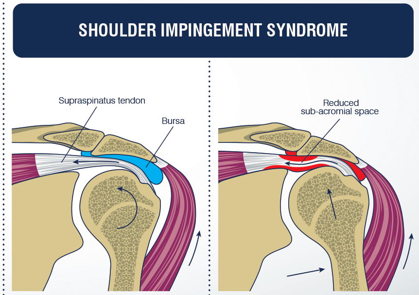 Why Do My Shoulder Clicking why-do-my-shoulder-clicking