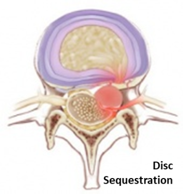 How Does A Herniated Disc Heal?