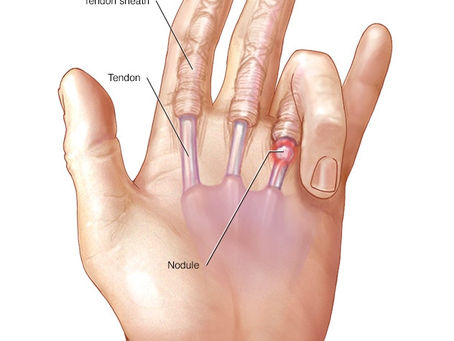 My finger is stuck! (Trigger Finger)