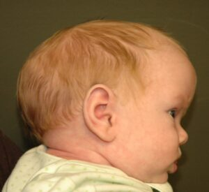 Bebê com escafocefalia