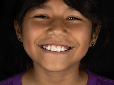 Micro Smile Design & natural aesthetics - Micro diseño de sonrisa en Tijuana.