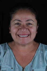 Full mouth restoration - Restauración dental completa y prótesis en Dental Group.