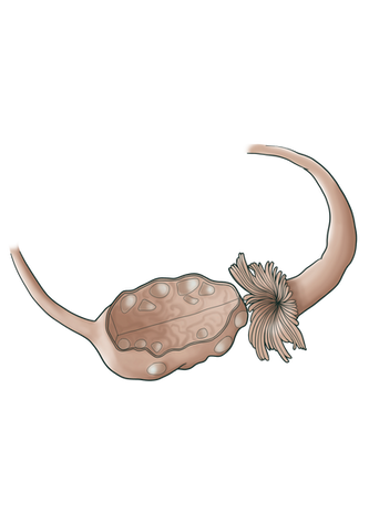 polycystic ovary pink isolated.png