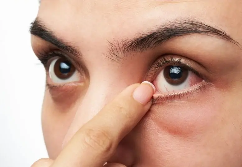 Mucous Fishing Syndrome: When a Habit Becomes a Vicious Cycle