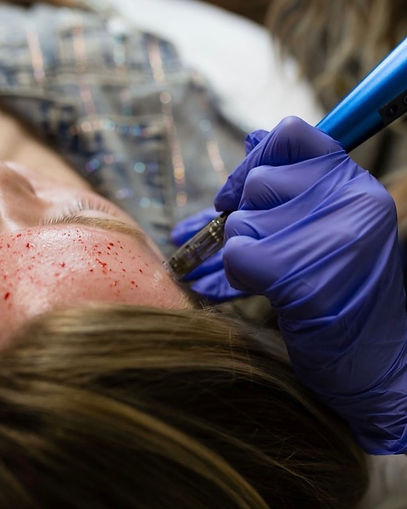 Microneedling.jpeg