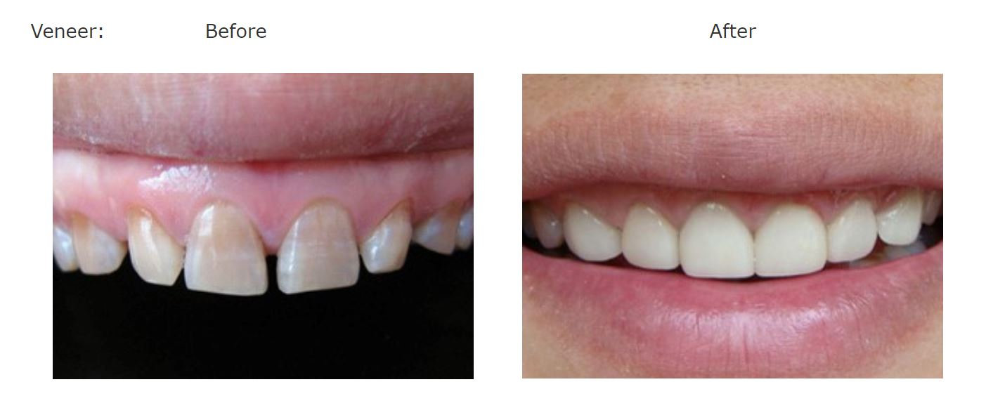 Hunterdon Family Dental Care Smile Gallery Cosmetic Dentistry Results Before After