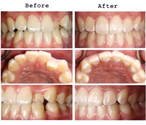 Hunterdon Family Dental Care Smile Gallery Invisalign Results Before After
