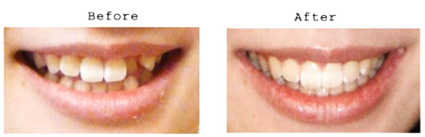 Hunterdon Family Dental Care Smile Gallery Invisalign Before After