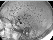 ACİL SERVİSTE ANEVRİZMAYA YAKLAŞIM